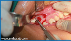Right tooth surgically exposed