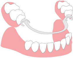 Removable-Dentures
