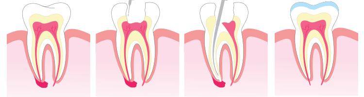 root-canal-treatment