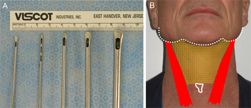 face_neck_liposuction