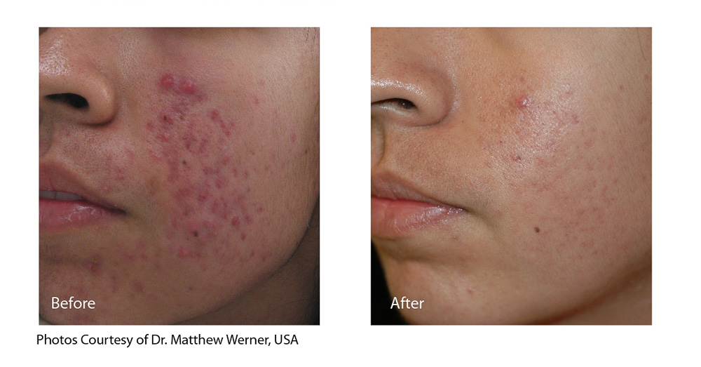 Spectra_Werner_AcneScarring_beforeandafter