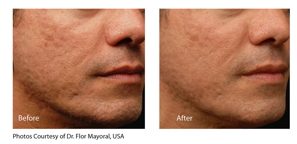 Infini_Mayoral_full_face_beforeandafter