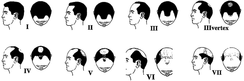 hairloss men