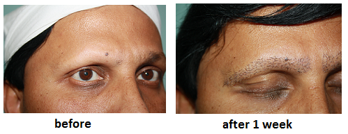 eyebrow hair transplant