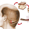 Follicular Unit Transfer (FUT)